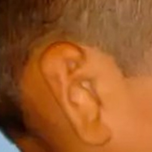 microtia-grade-2