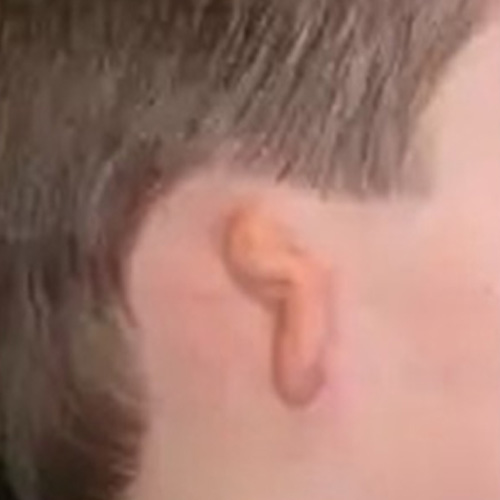 microtia-grade-3